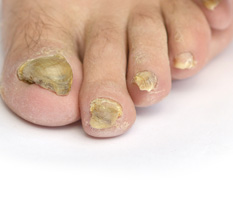 Ugly toe nails? How to get rid of Nail Fungus